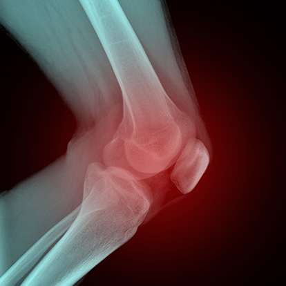 Inflammation