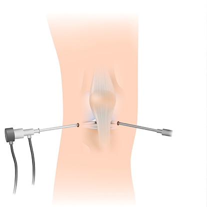 Arthroscopie