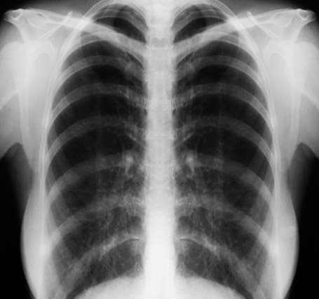 Radiographie du thorax