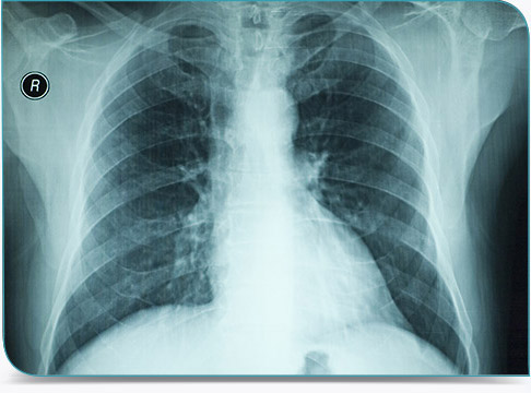Radiographie du thorax