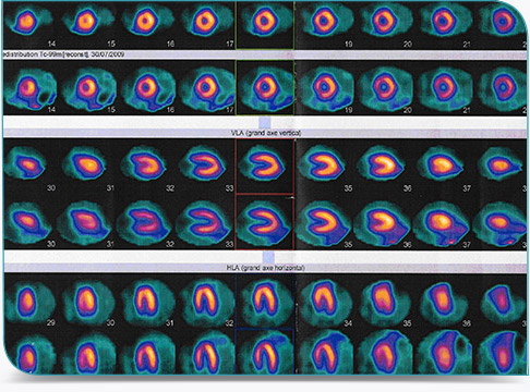 Scintigraphie cardiaque