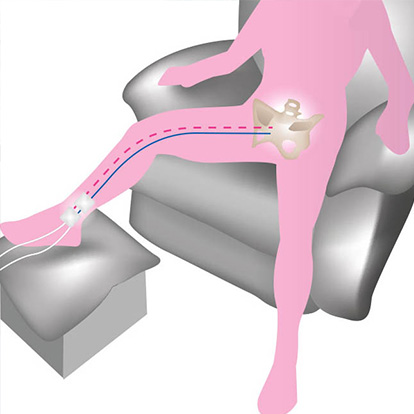Electrostimulation