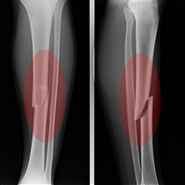 Antécédents de fracture