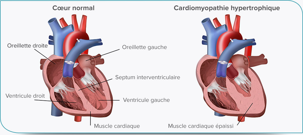 Cardiomyopathie
