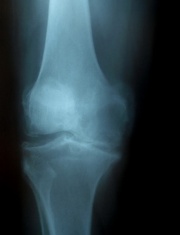 Les formes d’arthrose du genou