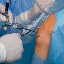 Arthroscopie thérapeutique