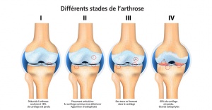 L’arthrose 